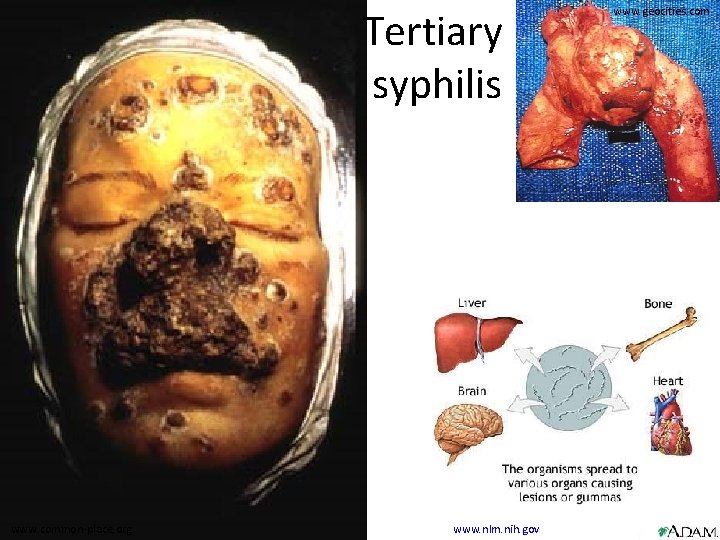 Tertiary syphilis www. common-place. org www. nlm. nih. gov www. geocities. com 