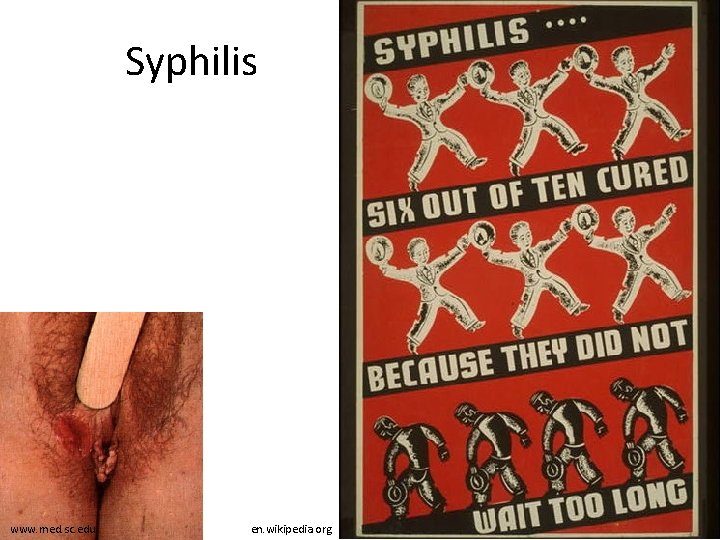 Syphilis www. med. sc. edu en. wikipedia. org 