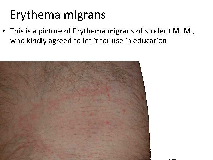 Erythema migrans • This is a picture of Erythema migrans of student M. M.