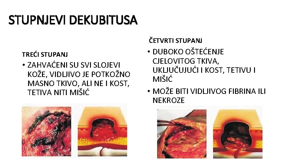 STUPNJEVI DEKUBITUSA ČETVRTI STUPANJ TREĆI STUPANJ • ZAHVAĆENI SU SVI SLOJEVI KOŽE, VIDLJIVO JE