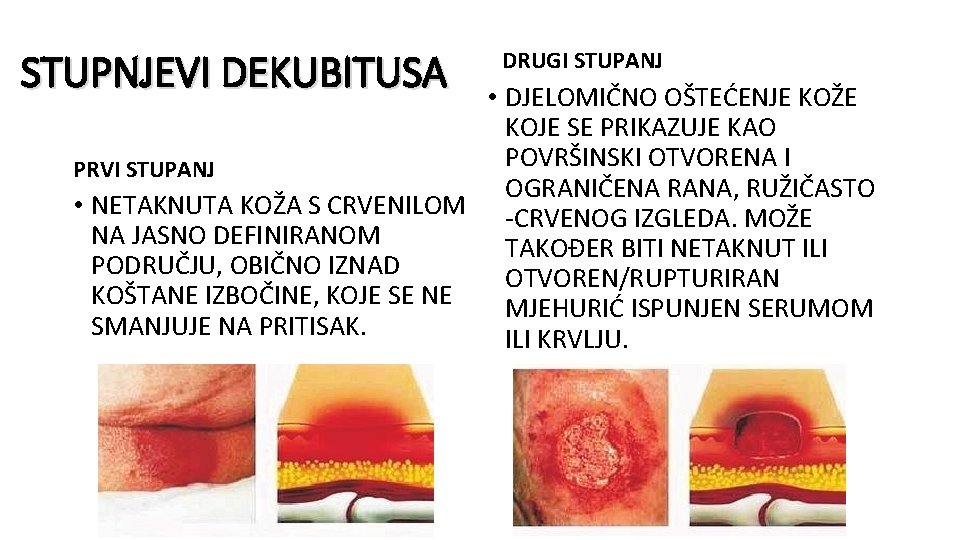 STUPNJEVI DEKUBITUSA DRUGI STUPANJ • DJELOMIČNO OŠTEĆENJE KOŽE KOJE SE PRIKAZUJE KAO POVRŠINSKI OTVORENA