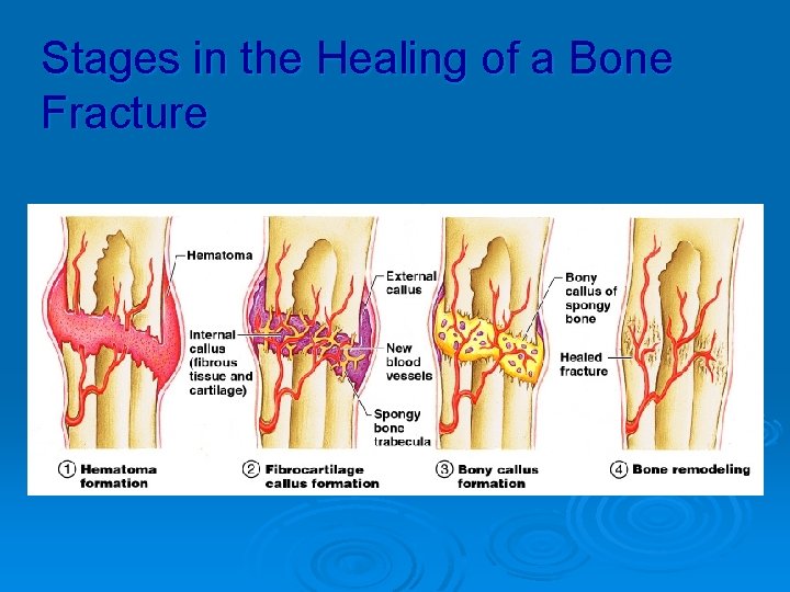 Stages in the Healing of a Bone Fracture 