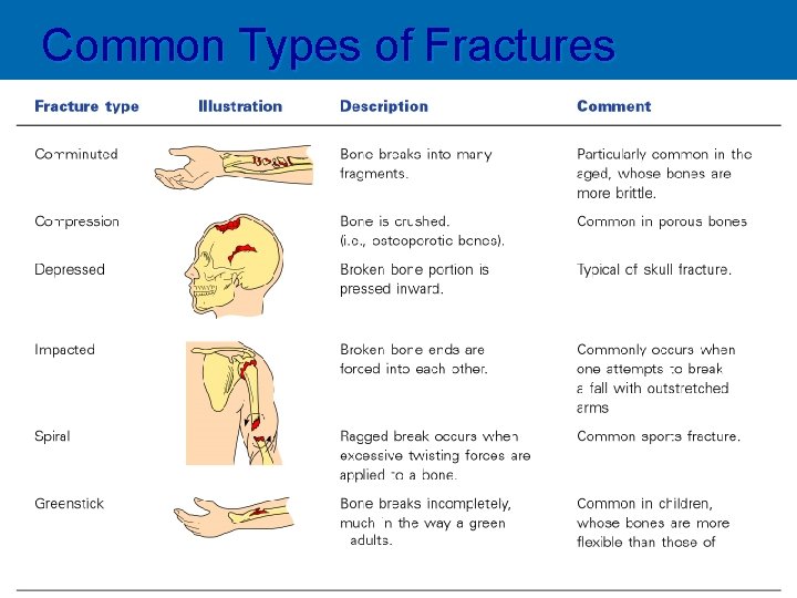 Common Types of Fractures Table 5. 2 Copyright © 2003 Pearson Education, Inc. publishing