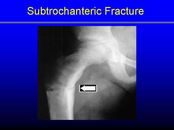 Subtrochanteric Fracture 