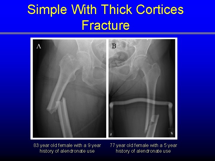 Simple With Thick Cortices Fracture 83 year old female with a 9 year history