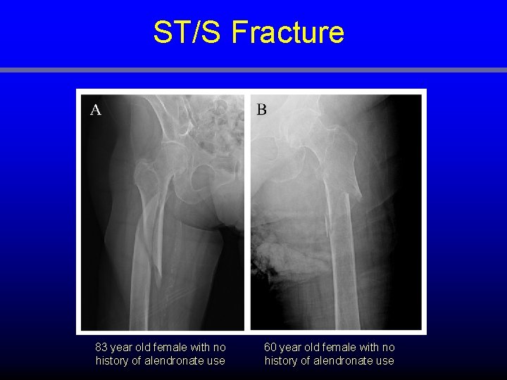 ST/S Fracture 83 year old female with no history of alendronate use 60 year