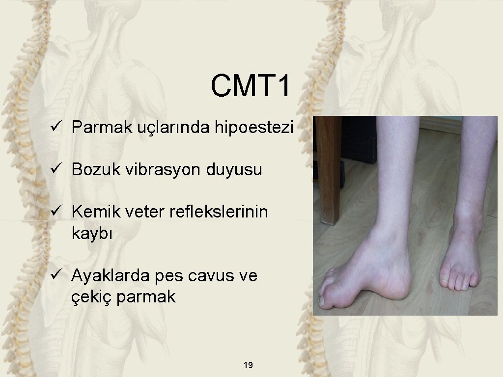 CMT 1 ü Parmak uçlarında hipoestezi ü Bozuk vibrasyon duyusu ü Kemik veter reflekslerinin