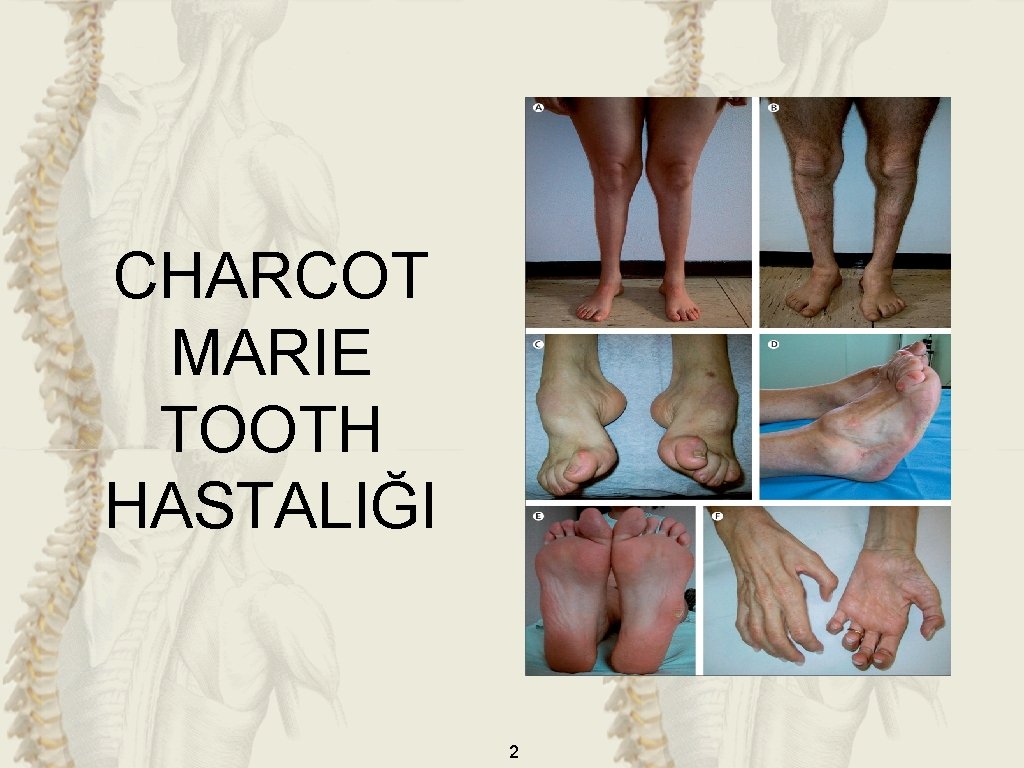 CHARCOT MARIE TOOTH HASTALIĞI 2 