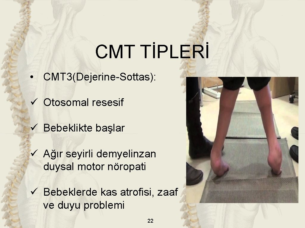 CMT TİPLERİ • CMT 3(Dejerine-Sottas): ü Otosomal resesif ü Bebeklikte başlar ü Ağır seyirli