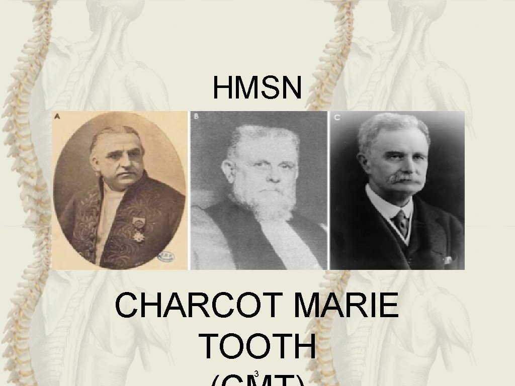 HMSN CHARCOT MARIE TOOTH 3 