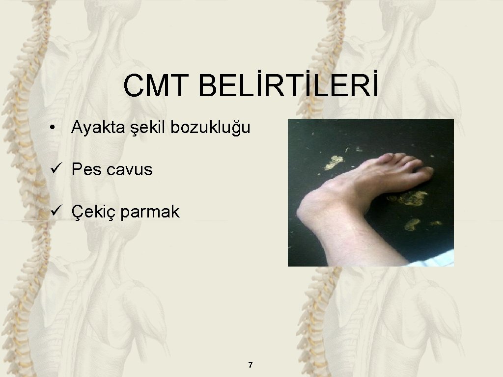 CMT BELİRTİLERİ • Ayakta şekil bozukluğu ü Pes cavus ü Çekiç parmak 7 