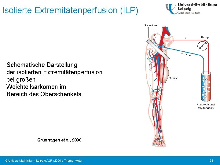 Isolierte Extremitätenperfusion (ILP) Schematische Darstellung der isolierten Extremitätenperfusion bei großen Weichteilsarkomen im Bereich des