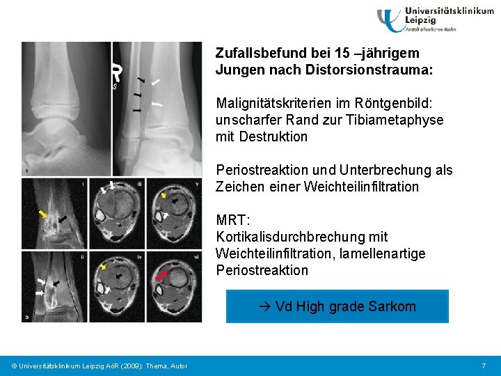 Zufallsbefund bei 15 –jährigem Jungen nach Distorsionstrauma: Malignitätskriterien im Röntgenbild: unscharfer Rand zur Tibiametaphyse