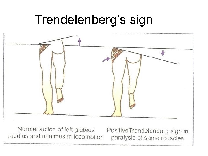 Trendelenberg’s sign 