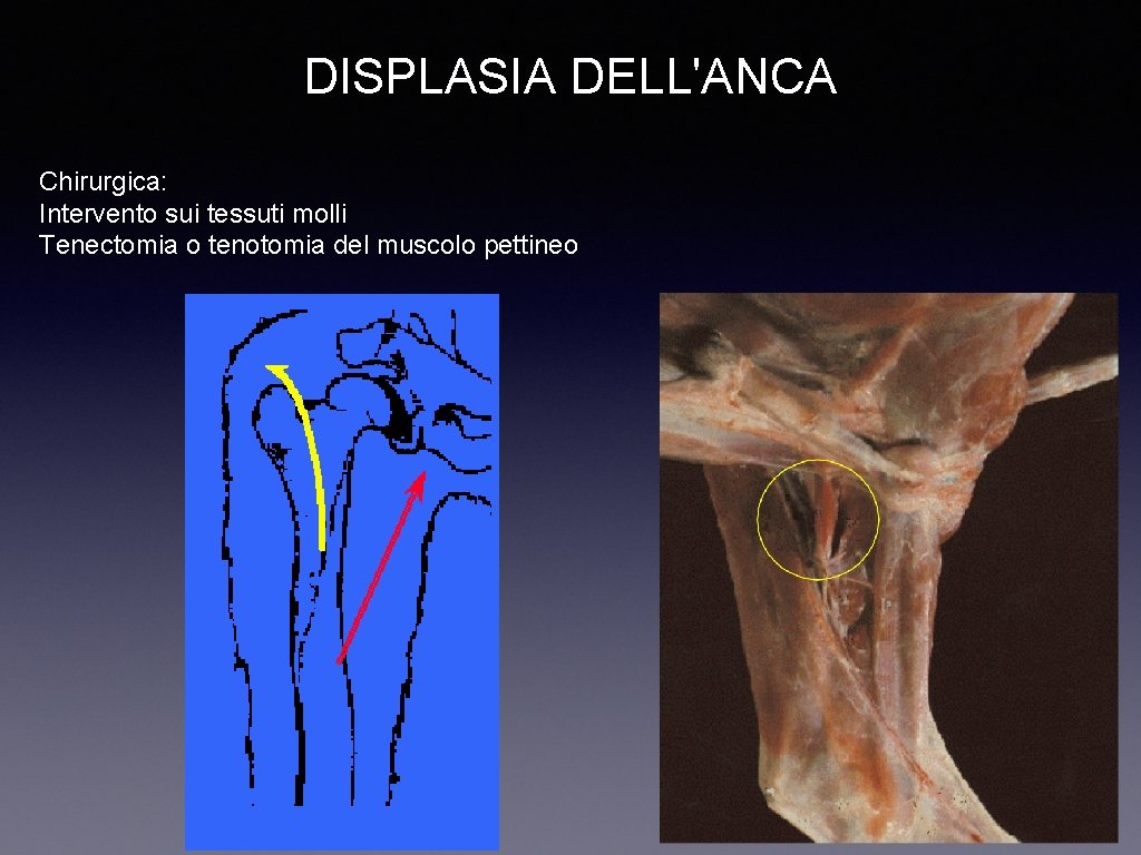 DISPLASIA DELL'ANCA Chirurgica: Intervento sui tessuti molli Tenectomia o tenotomia del muscolo pettineo 