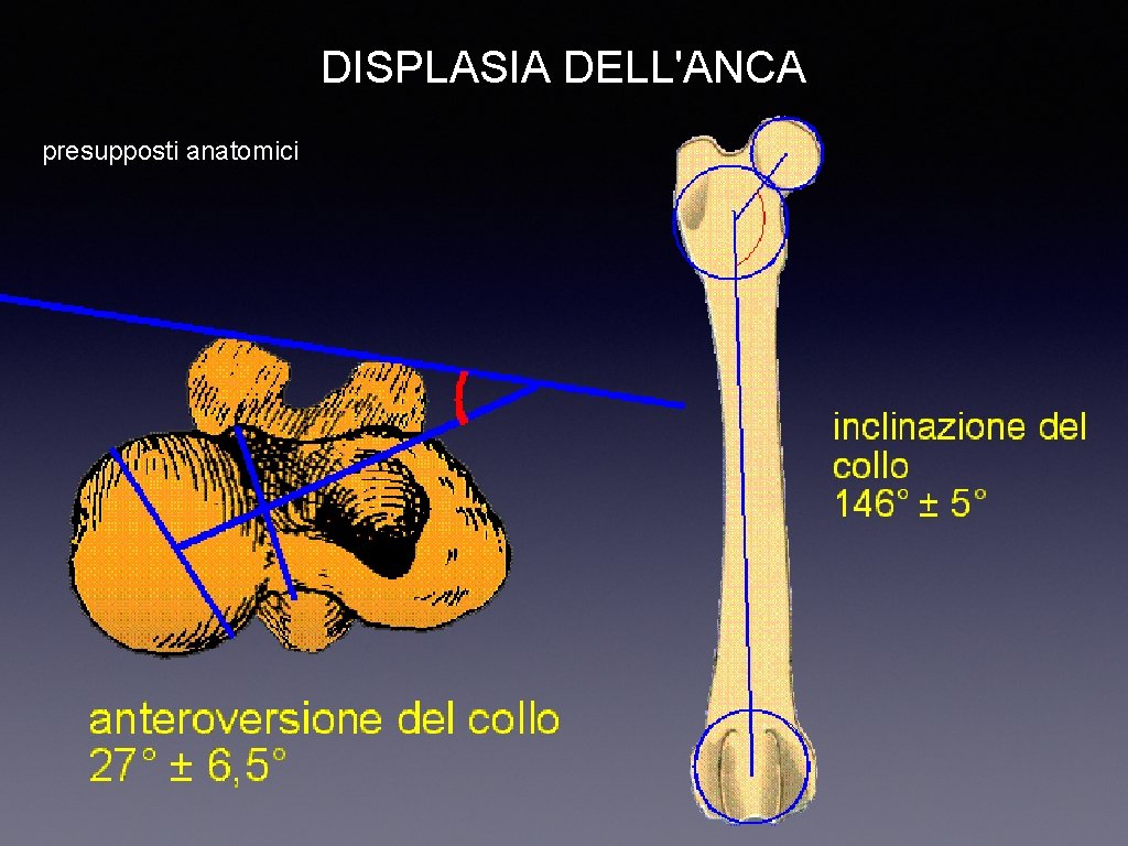 DISPLASIA DELL'ANCA presupposti anatomici 