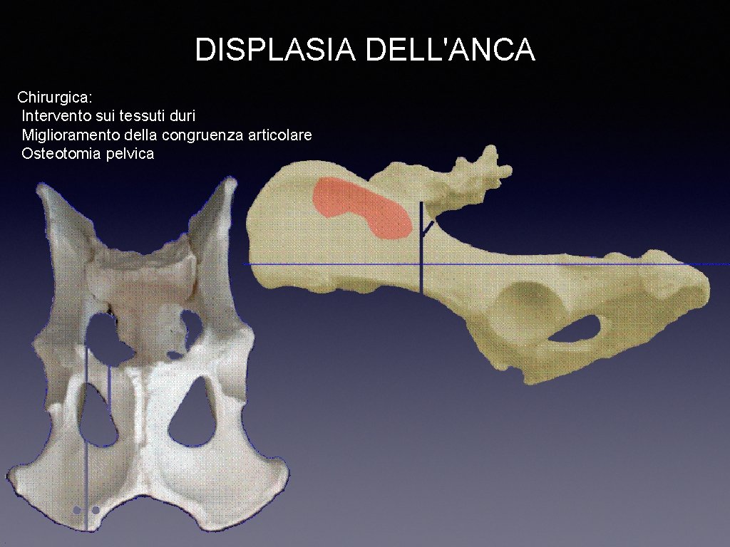 DISPLASIA DELL'ANCA Chirurgica: Intervento sui tessuti duri Miglioramento della congruenza articolare Osteotomia pelvica 