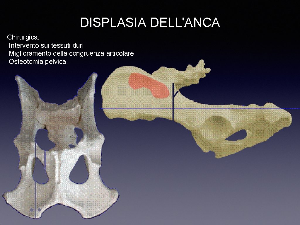 DISPLASIA DELL'ANCA Chirurgica: Intervento sui tessuti duri Miglioramento della congruenza articolare Osteotomia pelvica 