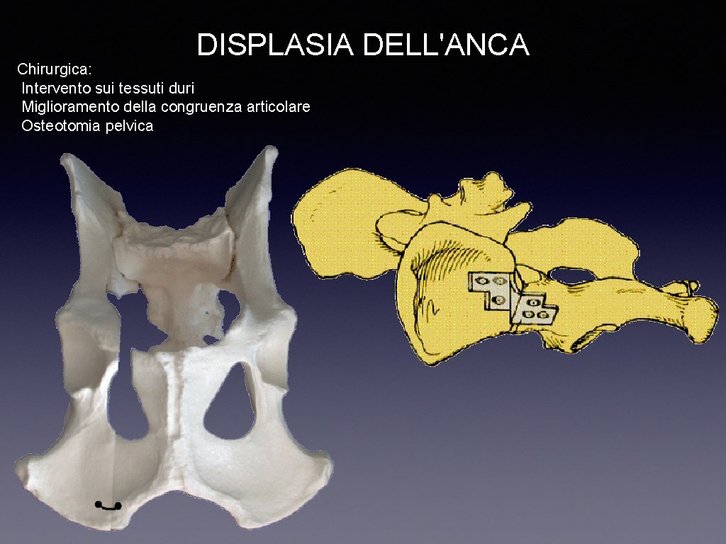 DISPLASIA DELL'ANCA Chirurgica: Intervento sui tessuti duri Miglioramento della congruenza articolare Osteotomia pelvica 