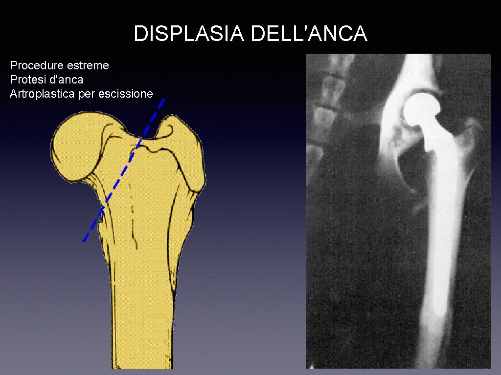 DISPLASIA DELL'ANCA Procedure estreme Protesi d'anca Artroplastica per escissione 