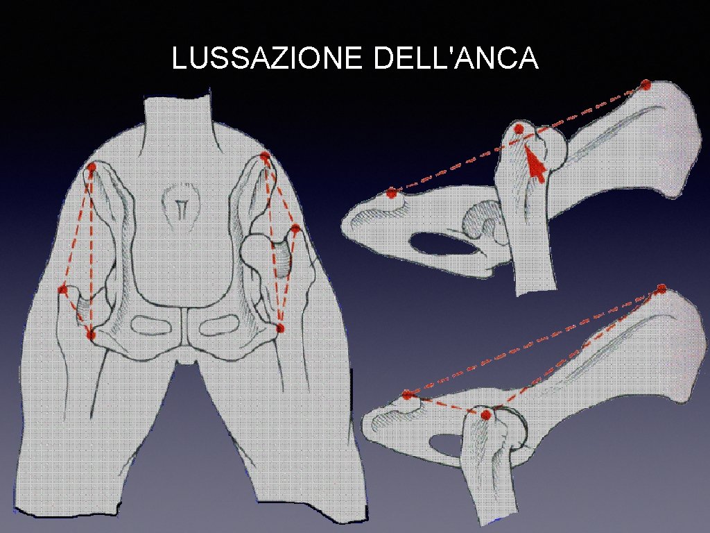 LUSSAZIONE DELL'ANCA 