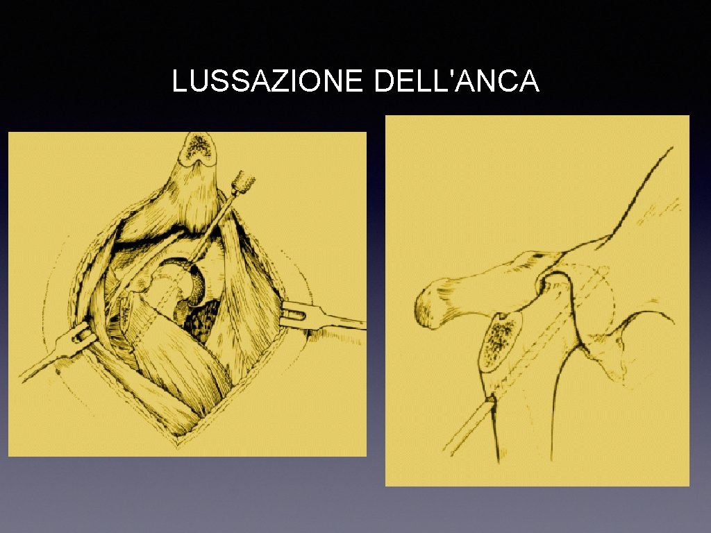 LUSSAZIONE DELL'ANCA 