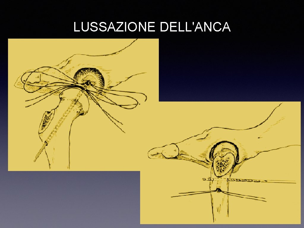 LUSSAZIONE DELL'ANCA 