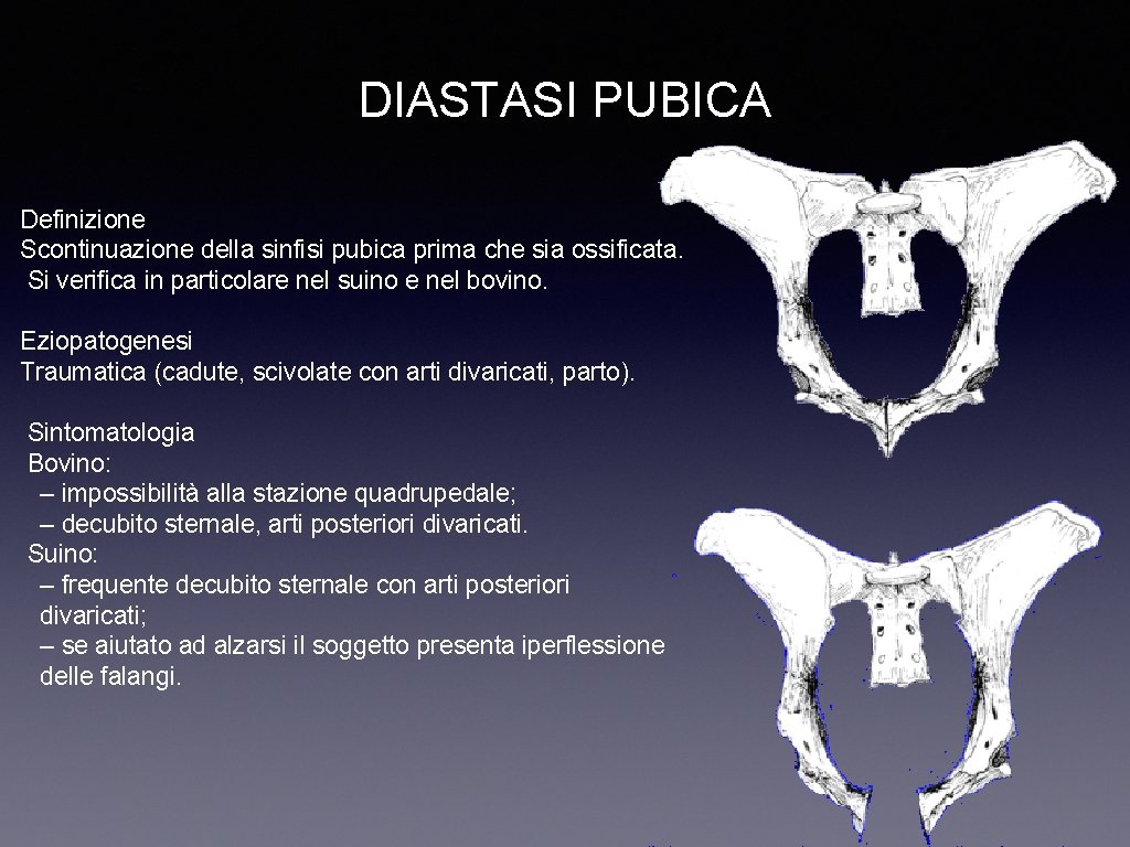 DIASTASI PUBICA Definizione Scontinuazione della sinfisi pubica prima che sia ossificata. Si verifica in