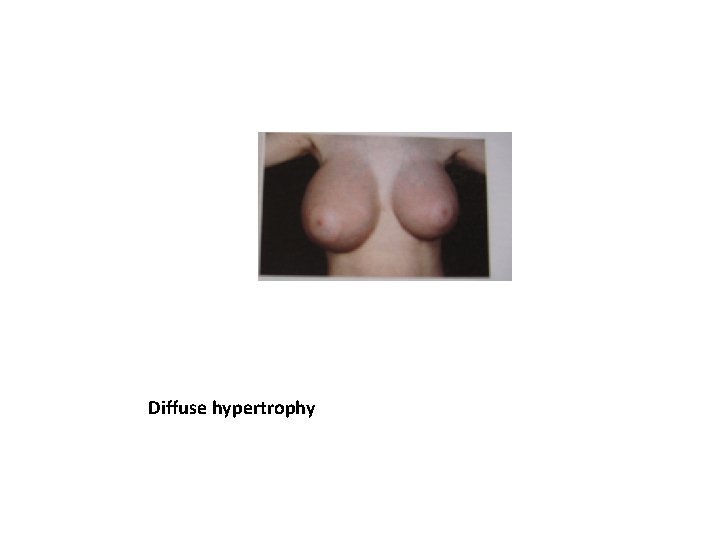 Diffuse hypertrophy 