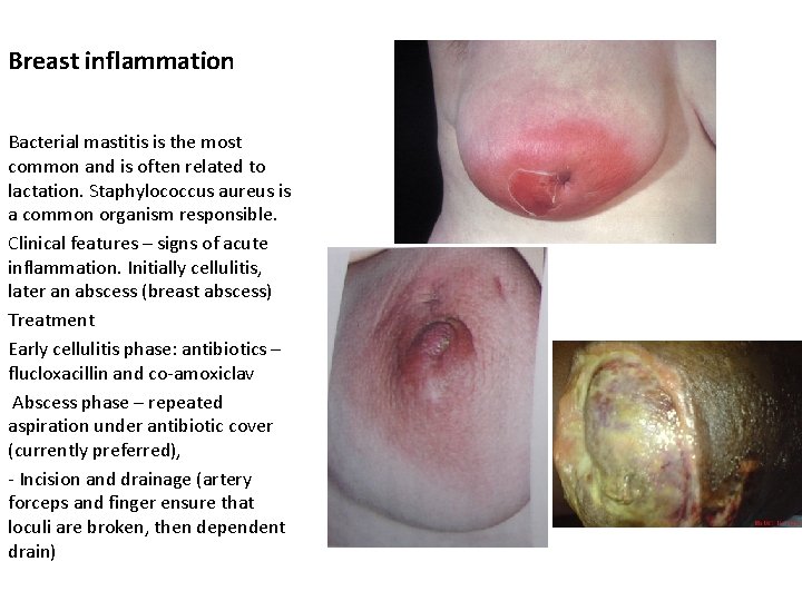 Breast inflammation Bacterial mastitis is the most common and is often related to lactation.