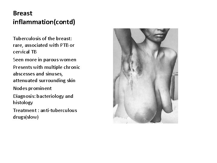 Breast inflammation(contd) Tuberculosis of the breast: rare, associated with PTB or cervical TB Seen