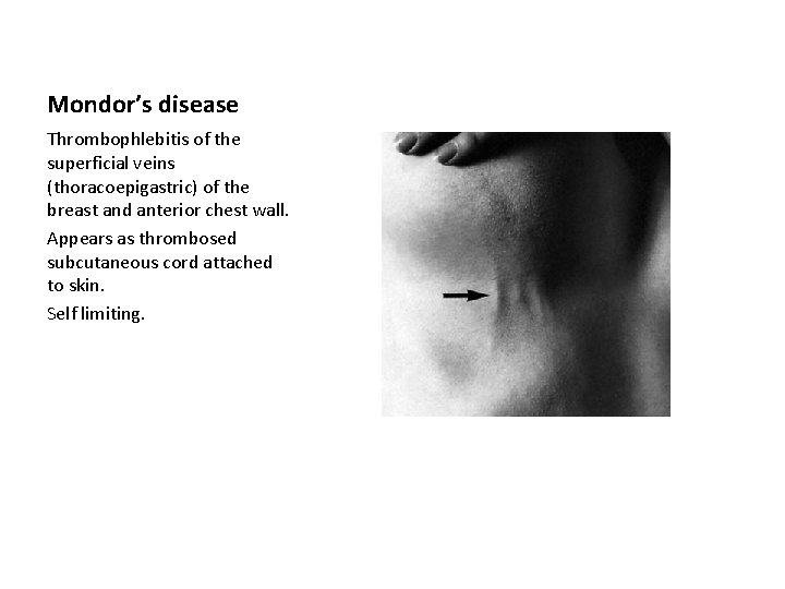 Mondor’s disease Thrombophlebitis of the superficial veins (thoracoepigastric) of the breast and anterior chest