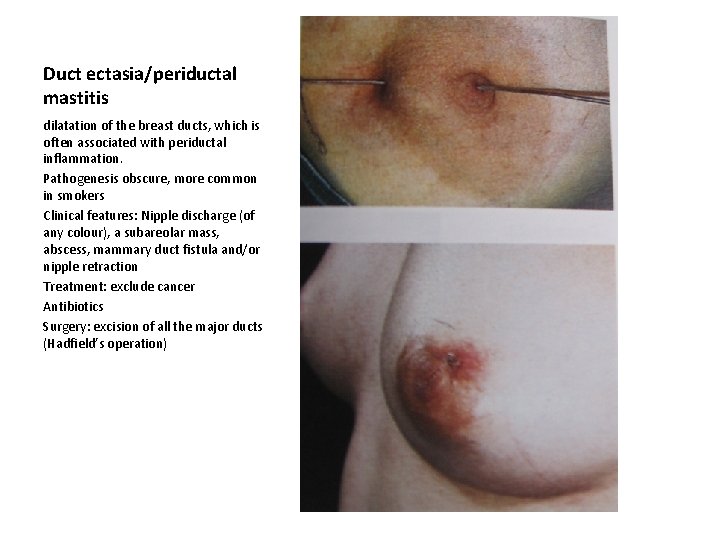 Duct ectasia/periductal mastitis dilatation of the breast ducts, which is often associated with periductal