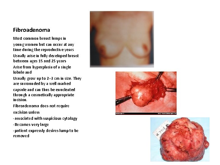 Fibroadenoma Most common breast lumps in young women but can occur at any time