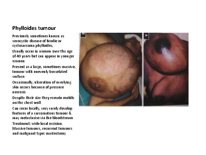 Phylloides tumour Previously sometimes known as serocystic disease of Brodie or cystosarcoma phylloides, Usually