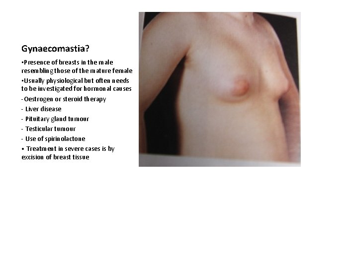 Gynaecomastia? • Presence of breasts in the male resembling those of the mature female