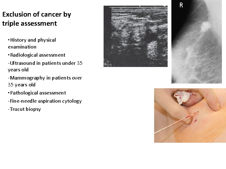 Exclusion of cancer by triple assessment • History and physical examination • Radiological assessment