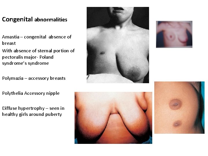 Congenital abnormalities Amastia – congenital absence of breast With absence of sternal portion of