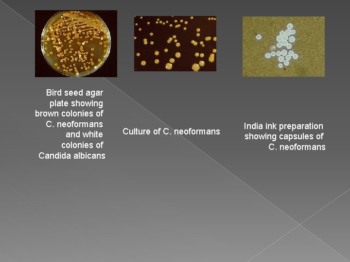Bird seed agar plate showing brown colonies of C. neoformans and white colonies of Bird seed agar plate showing brown colonies of C. neoformans and white colonies of