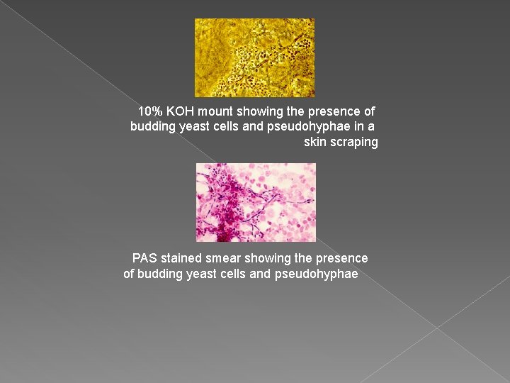 10% KOH mount showing the presence of budding yeast cells and pseudohyphae in a