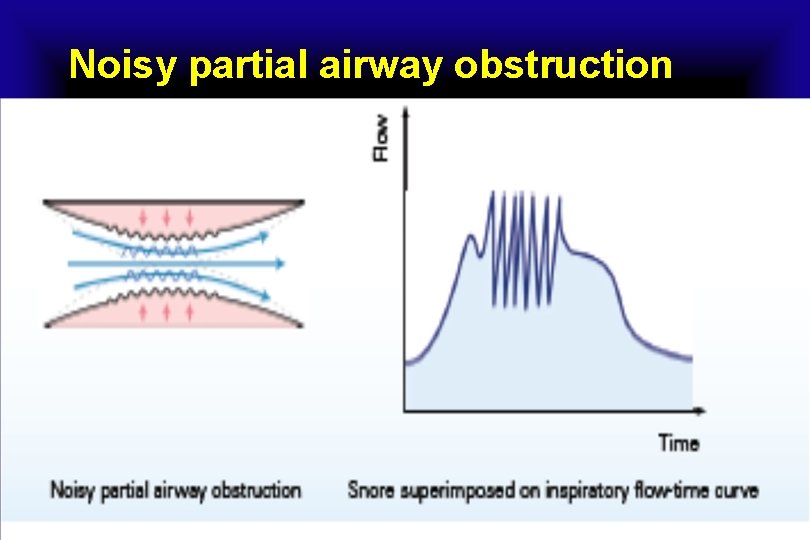 Noisy partial airway obstruction 