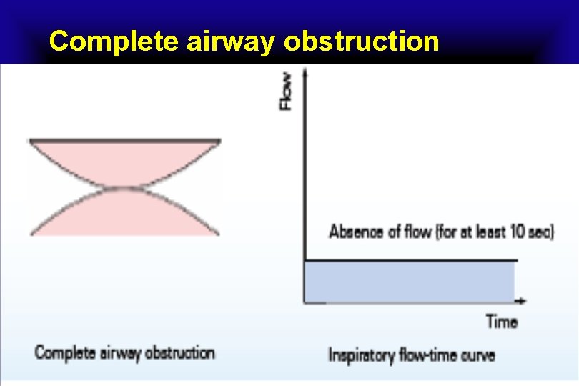 Complete airway obstruction 