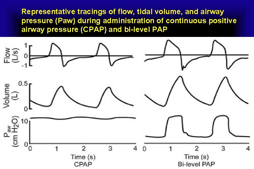 Representative tracings of flow, tidal volume, and airway pressure (Paw) during administration of continuous