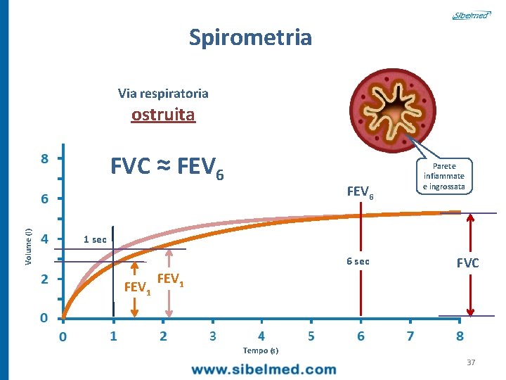 Spirometria Via respiratoria ostruita Volume (l) FVC ≈ FEV 6 Parete infiammate e ingrossata