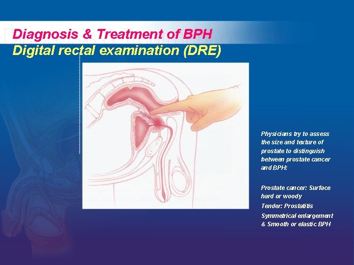 Diagnosis & Treatment of BPH Digital rectal examination (DRE) Physicians try to assess the