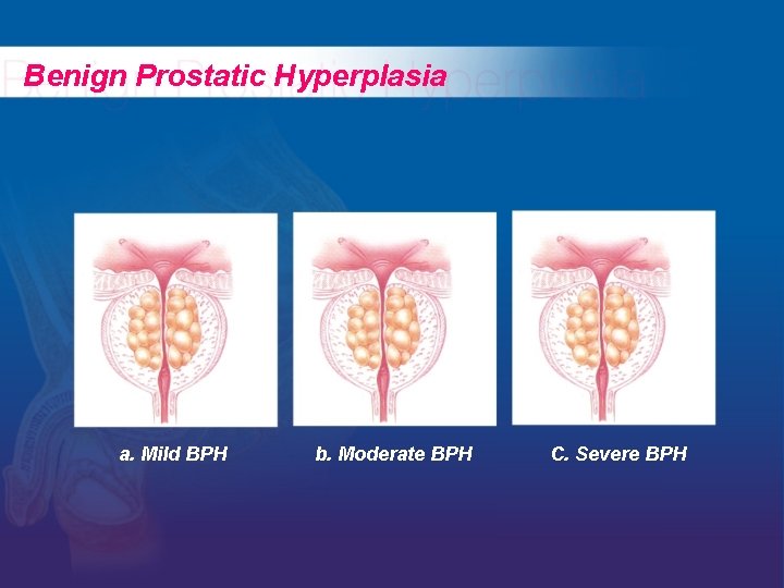 Benign Prostatic Hyperplasia a. Mild BPH b. Moderate BPH C. Severe BPH 
