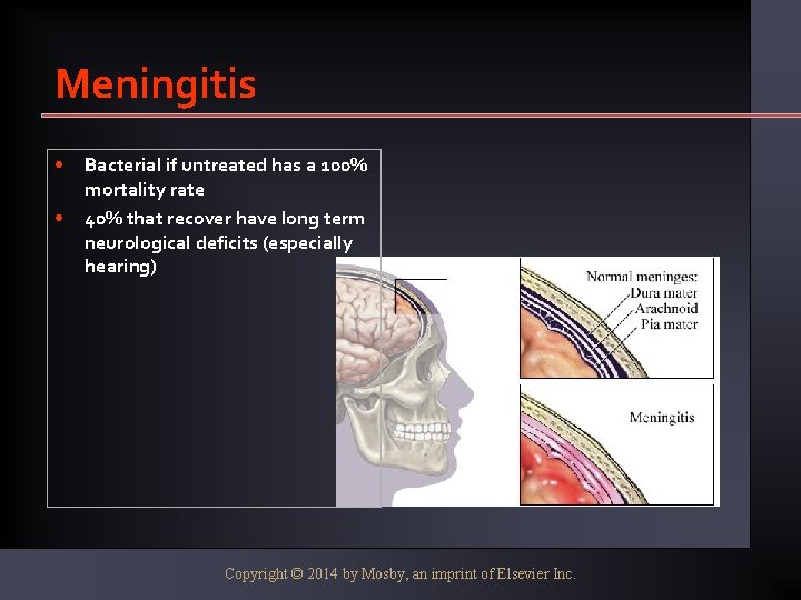 Meningitis • • Bacterial if untreated has a 100% mortality rate 40% that recover