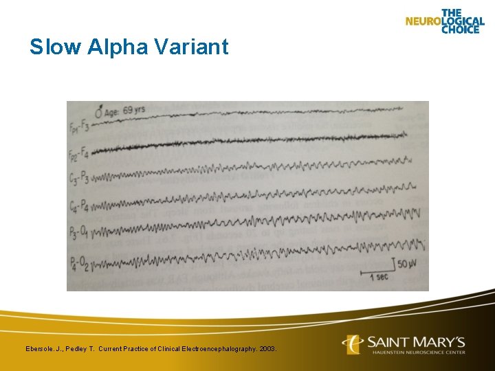 Slow Alpha Variant Ebersole. J. , Pedley T. Current Practice of Clinical Electroencephalography. 2003.