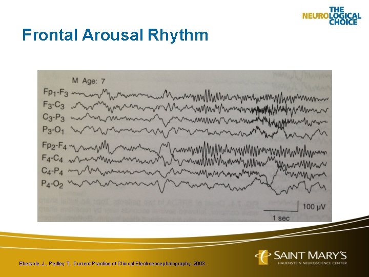 Frontal Arousal Rhythm Ebersole. J. , Pedley T. Current Practice of Clinical Electroencephalography. 2003.
