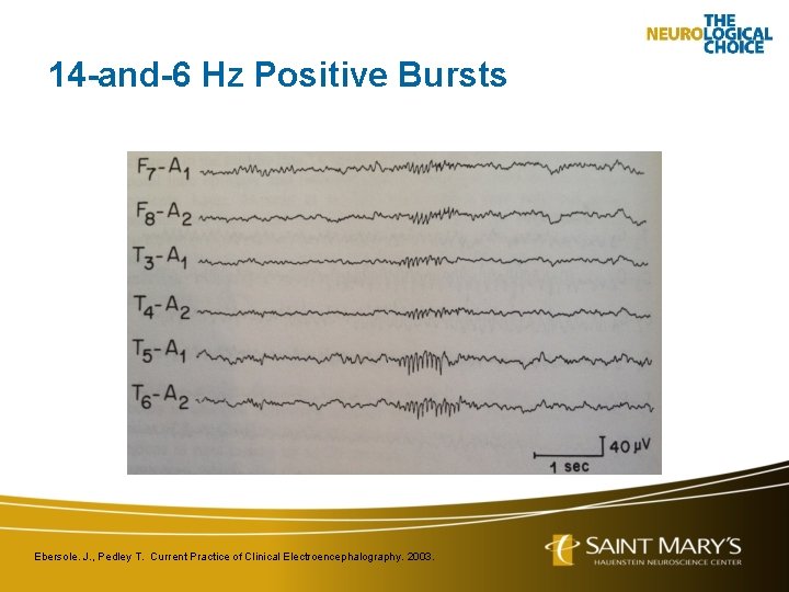 14 -and-6 Hz Positive Bursts Ebersole. J. , Pedley T. Current Practice of Clinical